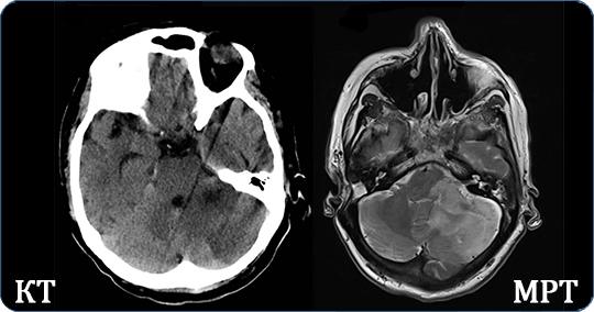 На снимке два изображения головного мозга выполненных способами КТ и МРТ 