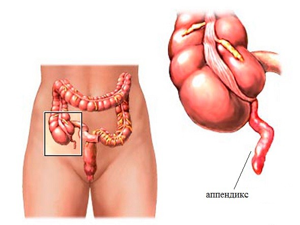 схема нахождения аппендицита в брюшной полости