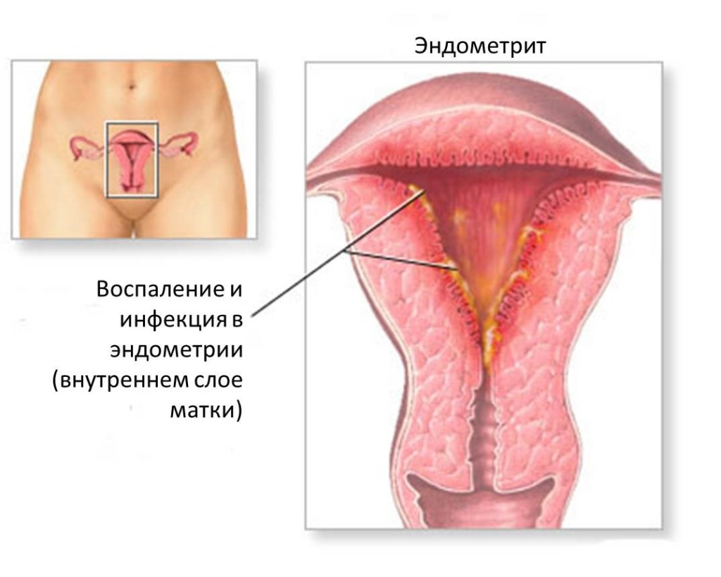 воспаление в эндометрии эндометрит