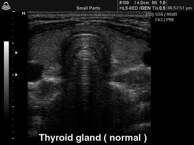 УЗИ-картина щитовидной железы в нормальном состоянии (без изменений)