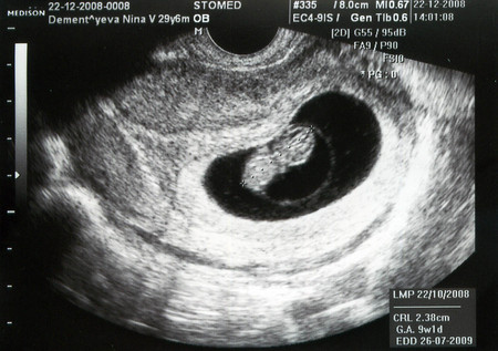 эмбрион в 7 недель беремнности