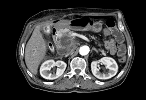 МР-томограмма опухоли поджелудочной железы