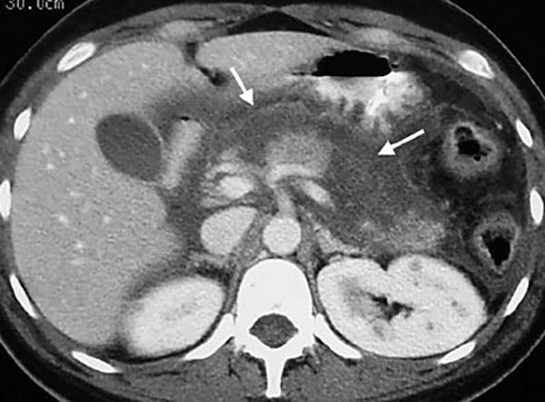 МР-томограмма поджелудочной железы с панкреатитом