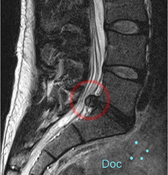 На снимке МРТ красным выделено межпозвоночная грыжа
