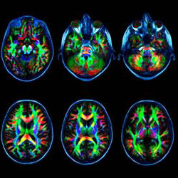 Снимок головного мозга после МРТ с контрастом