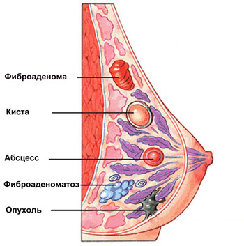 Виды опухолей молочной железы