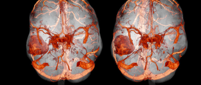 КТ головного мозга с контрастом
