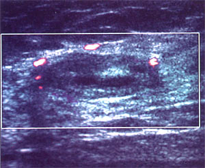 Допплерография молочной железы.Огибающий кровоток фиброаденомы