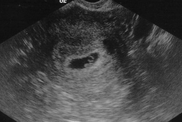 Снимок УЗИ первой недели беременности