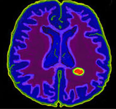 МРТ снимок мозга с контрастом