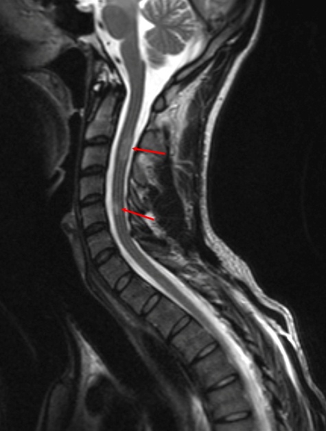 Очаги демиелинизации в спинном мозге при рассеянном склерозе в шейном отделе на снимке МРТ