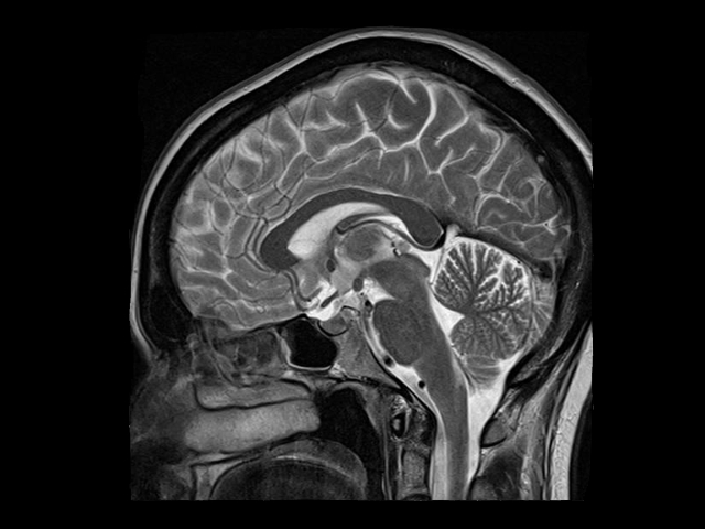 Снимок МРТ головного мозга здорового человека