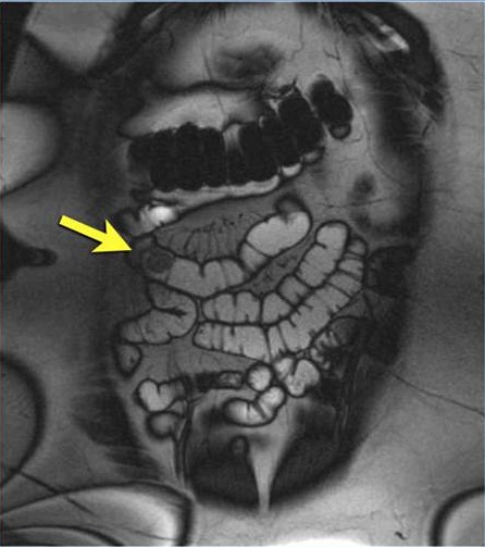 Гемангиома на снимке МРТ кишечника