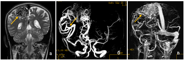 МРТ головного мозга нааксиальной и фронтальной проекциях в режиме T_2(а, б). В проекции межножковой цистерны эксцентрично справа определяется неправильной формы гипоинтенсивный участок. На МР-ангиограмме (в) участок представляет собой конгломерат аномально развитых сосудов, исходящий из правой задней коммуникантной артерии 