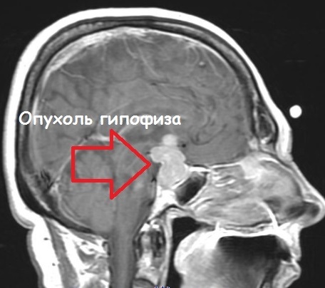 На КТ снимке головного мозга отчетливо видна опухоль