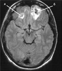 Ушиб головного мозга, лобных долей: а - справа - легкой степени; б - слева - средней степени