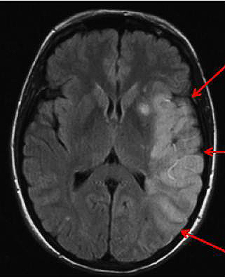 На снимке МРТ стрелкой указана черепно-мозговая травма