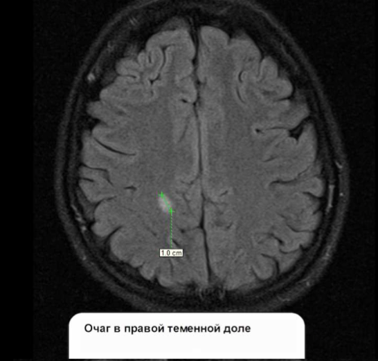 На снимке МРТ головы отчетливо виден очаг в правой теменной доле