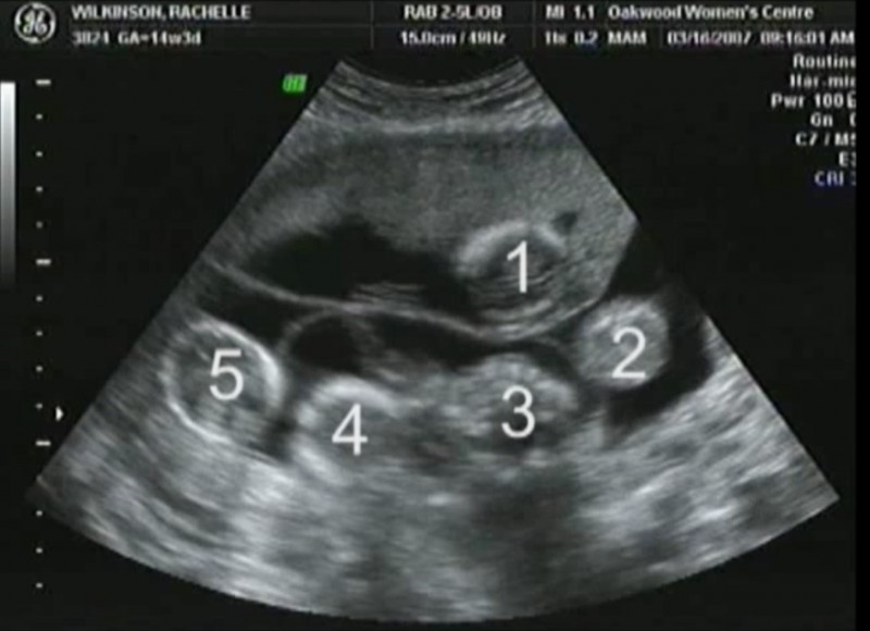 На снимке УЗИ многоплодная беременность, 5 эмбрионов