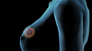 опухоль видна на схематичном изображении груди
