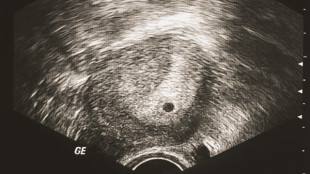 Изображение второй недели беременности на УЗИ