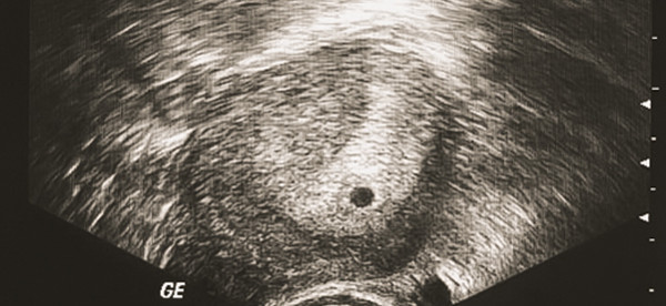 Изображение второй недели беременности на УЗИ