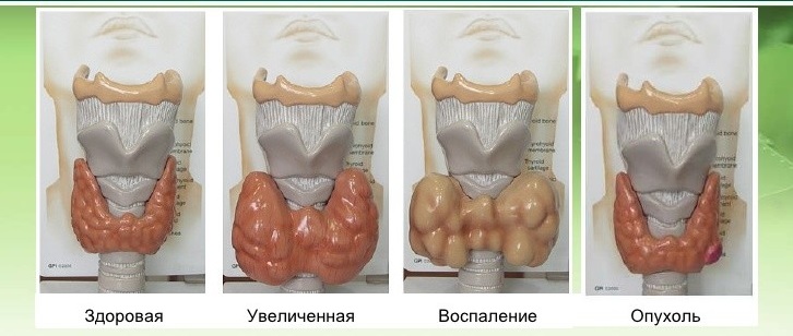 Объемные изображения щитовидной железы при различных болезнях в виде увеличения органа или же наличия новообразований