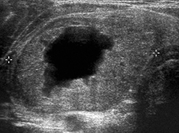 УЗИ-изображение рака щитовидной железы в виде темной области на органе