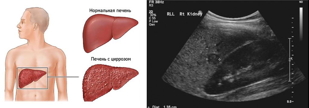 Изображение здоровой печени и пораженной циррозом, а также УЗИ-картина органа