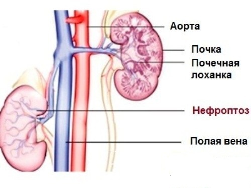 Нефроптоз