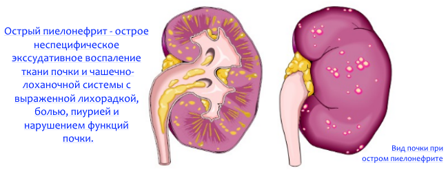 изображение почки при пиелонефрите схематичное