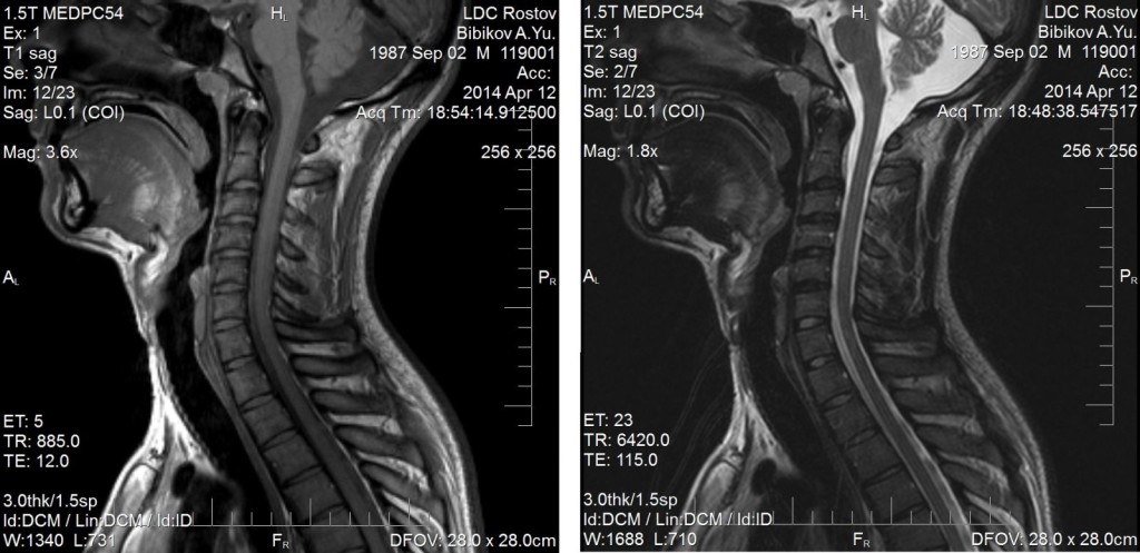 МР-томограмма шейного отдела позвоночника с применением контраста и без