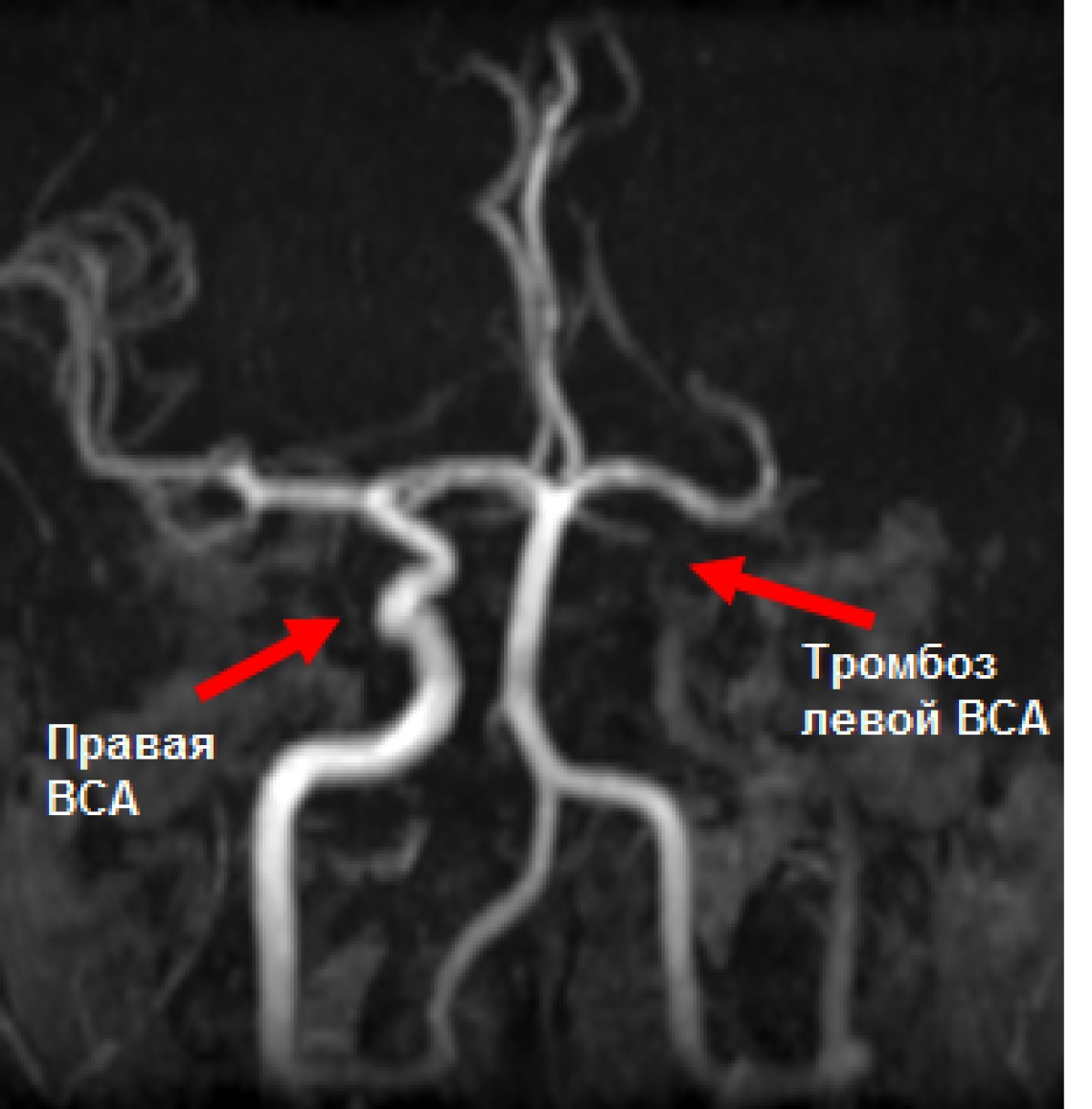 Тромбоз артерии мозга