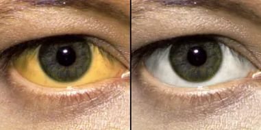 желтые склеры глаз