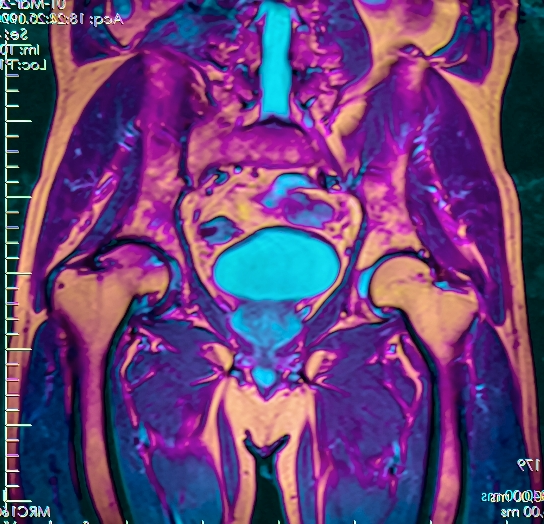 МРТ органов малого таза с контрастом