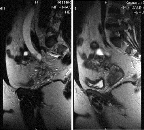 На снимке МРТ эндометриоидное поражение мечеточников