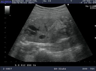 Снимок УЗИ с замершей беременостью
