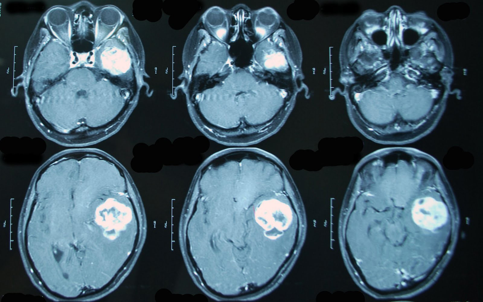 МРТ головного мозга (опухоль на снимке)