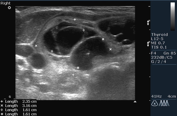 Множественные узлы и кистозные образования в увеличенной правой доле щитовидной железы.