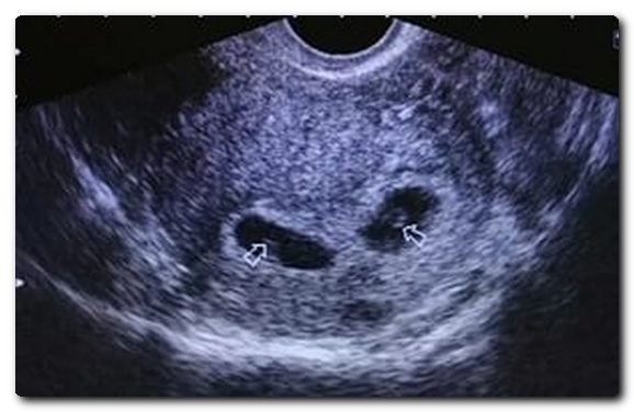 Начиная с 20 дня после эмбриональной подсадки врачом проводится УЗИ, которое дает возможность рассмотреть плодное яйцо полностью.