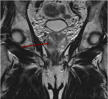 На снимке МРТ красной стрелкой указан рак правой доли предстательной железы