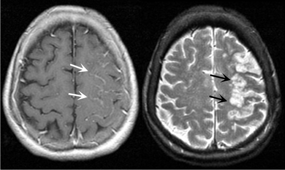 Стрелками на снимке МРТ показан ишемический инсульт