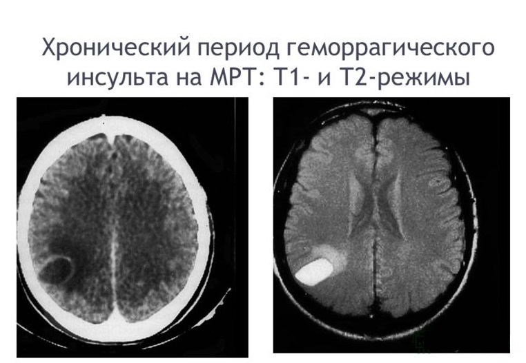 Ишемический инсульт головного мозга на мрт фото