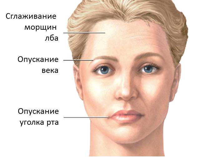 Признаки паралича лицевых нервов