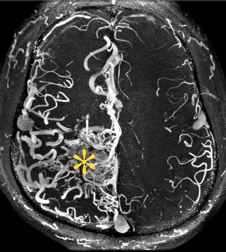 На снимке МРТ головного мозга желтым выделено место подверженное артериовенозной мальтиформацией
