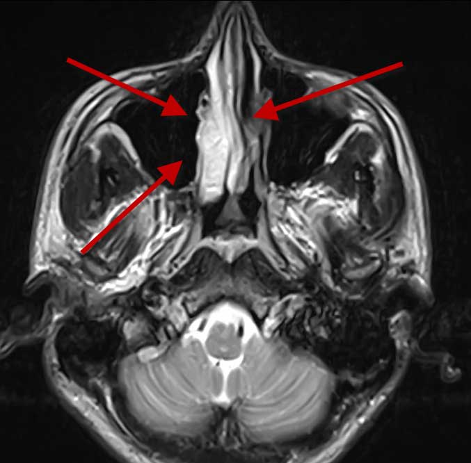 Снимок МРТ носа, стрелкой указывает на область с гайморитом
