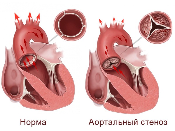 На рисунке сравнение здорового сердца и с аортальный стенозом