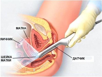 При помощи датчика специалист проводит ультразвуковое исследование шейки матки через влагалище